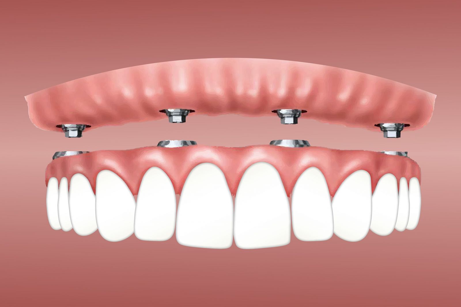 Segnini explica que a colocação de um implante dentário oferece um suporte estável para a prótese, que é um dente artificial