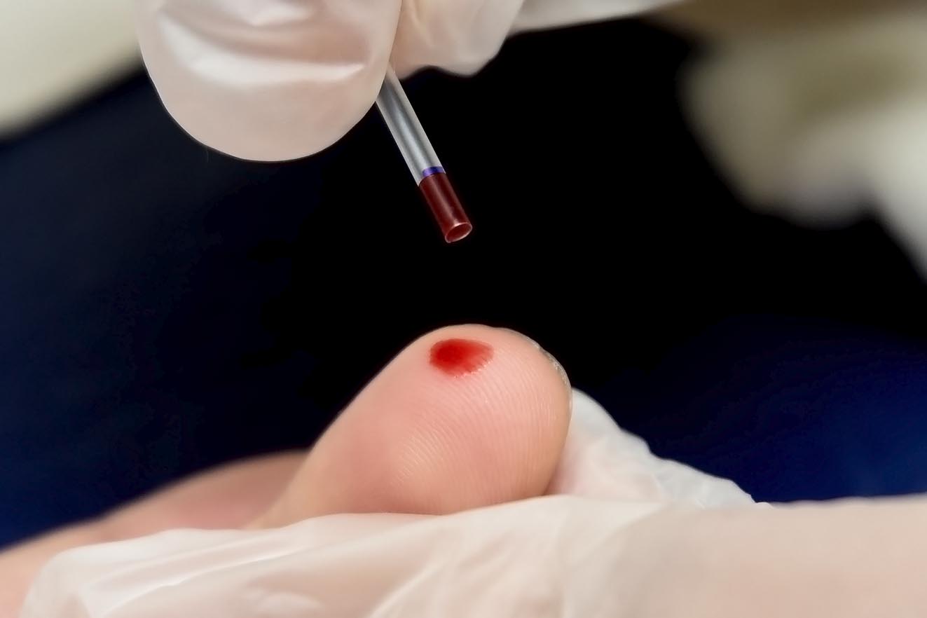 Julho Amarelo: diagnóstico precoce de hepatites virais pode evitar evolução do quadro para cirrose