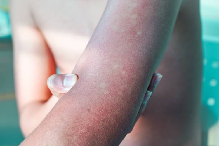 Araraquara se aproxima dos 300 casos de dengue; 7 de chikungunya, diz boletim