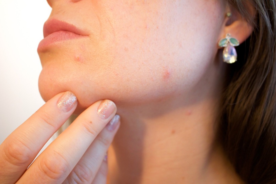 Dermatologista explica como cuidar da acne no inverno