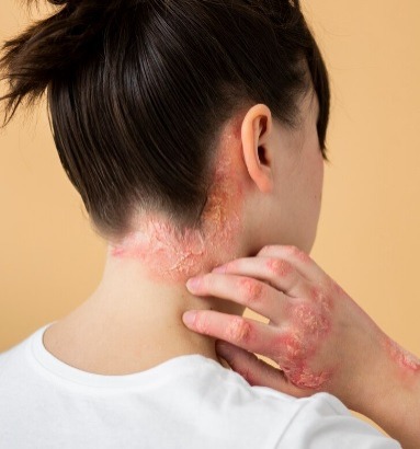 Dermatite atópica: doença não se restringe apenas ao público infantil; veja sintomas e tratamentos