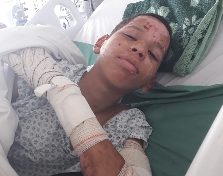 Araraquarense pede ajuda após filho sofrer queimaduras em acidente com álcool