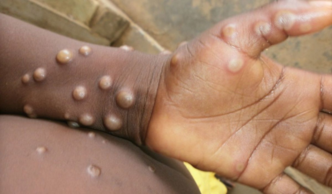 Estado confirma primeiro caso de Mpox em Araraquara