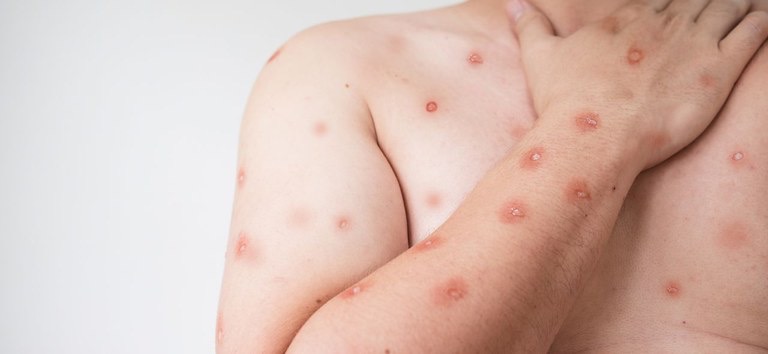 Paciente com MPOX está em quarentena e é acompanhado por equipes de saúde em Araraquara