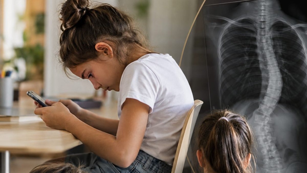 Escoliose infantil: sinais na postura que os pais devem observar