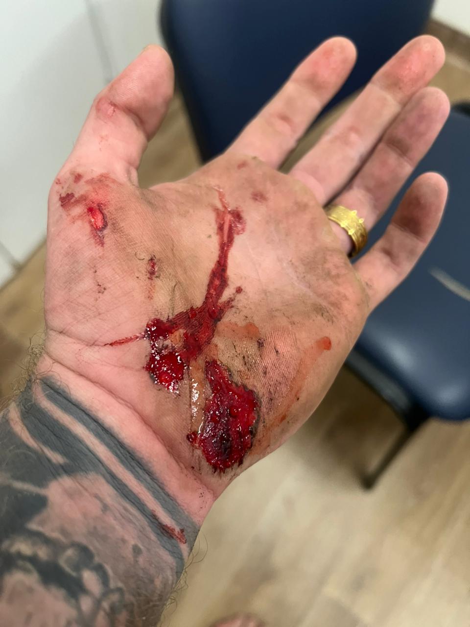 Mão do motocilista bastante machucada após acidente